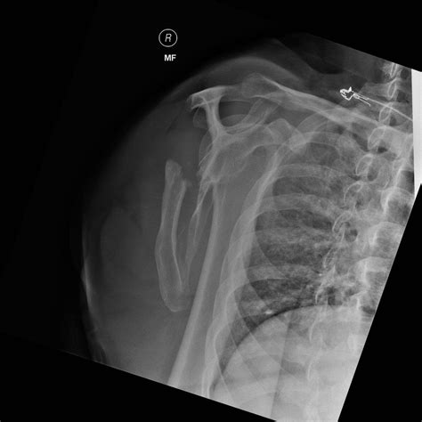 Scapular fracture | Scapular, Fracture, Radiology