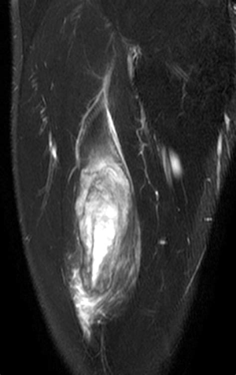 Myositis Ossificans | Radsource