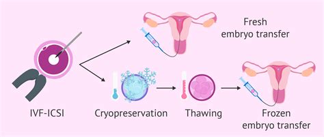 How Does the Frozen Embryo Transfer (FET) Procedure Work?