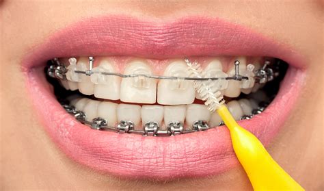 ¿Cómo realizar una correcta higiene dental con brackets? - Grupo Dental Cibeles