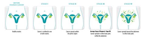 Types and Stages - ovarian.org