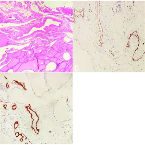 Microscopic view of the thyroid hemangioma. (a) The lesion consisted of ...