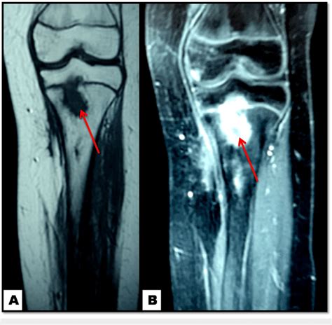 Knee MRI: osteomyelitis of the proximal tibia (red arrows) at six ...