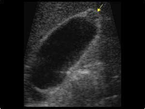 Abdomen and retroperitoneum | 1.2 Gallbladder and bile ducts : Case 1.2.10 Gallbladder ...