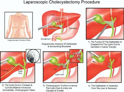 Figure 2. A laparoscopic cholecystectomy with intraoperative ...