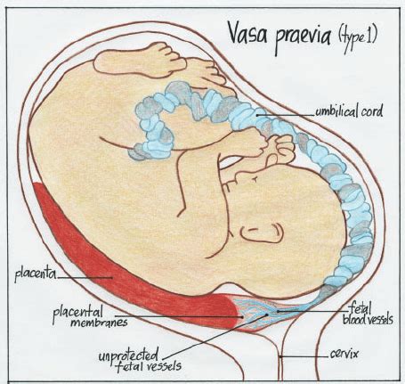 Illustration of vasa praevia type 1. | Download Scientific Diagram