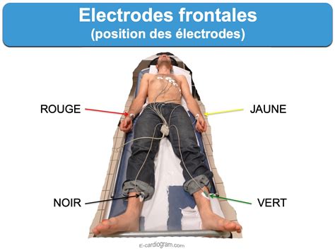 Electrodes frontales : e-cardiogram