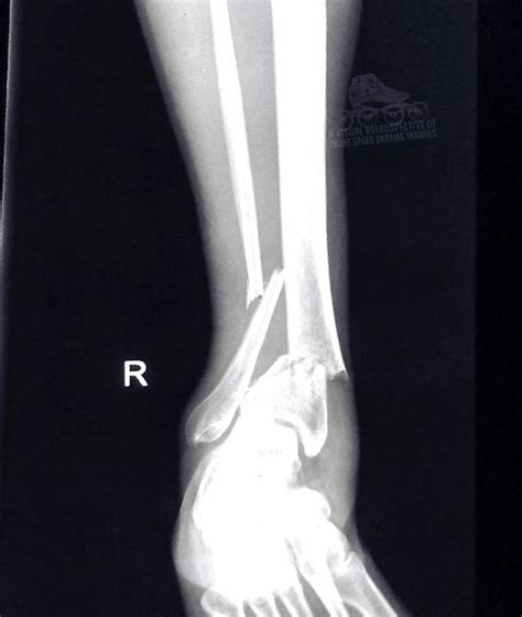 BROKEN ANKLE | buyxraysonline