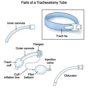 Tracheostomy Care