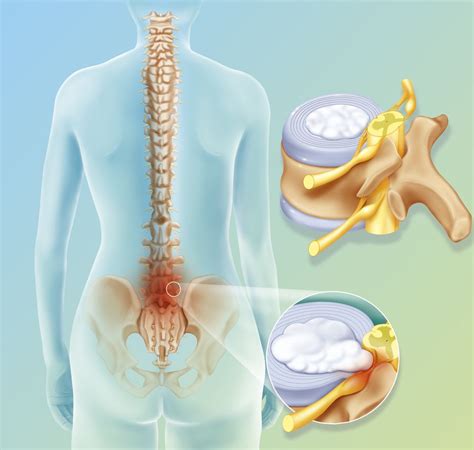 Reasons for Revision Spine Surgery