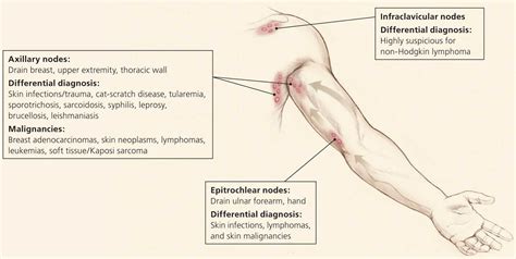 Axillary lymphadenopathy causes, diagnosis & treatment