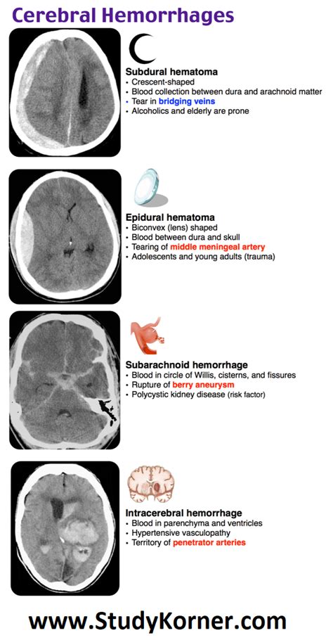 An epidural hematoma presents as a hyperdense lenticular shaped ...