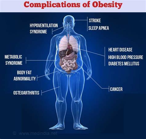 Obesity - Causes, Symptoms, Diagnosis, Complications, Treatment