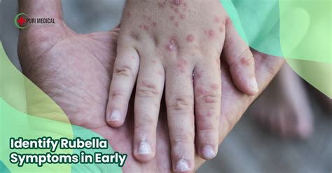 Identify Rubella Symptoms Early - Puri Medical - Dentist Bali