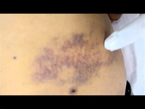 Bruise | Bruises meaning in Hindi| Ecchymosis | Bluish discolouration of skin after trauma - YouTube