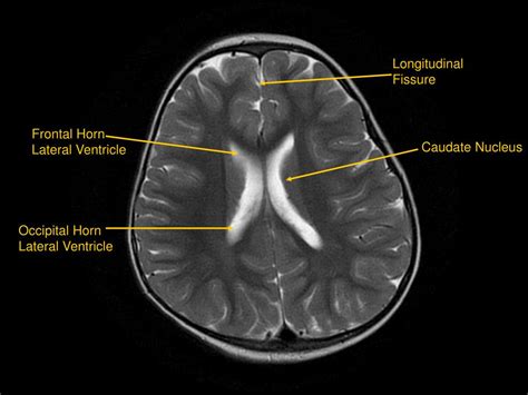 PPT - MRI of Brain/Head and Neck PowerPoint Presentation, free download - ID:601876