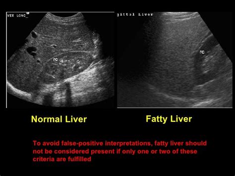 Fat Tissue On Liver - Hard Sex Tube