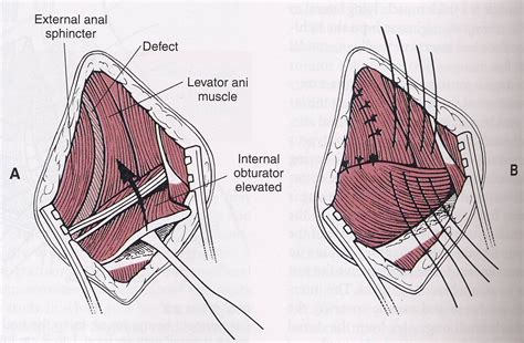 Anterior Perineal Hernia