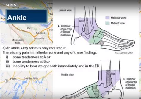 Ottawa Rules for Knee and Ankle — OrthopaedicPrinciples.com