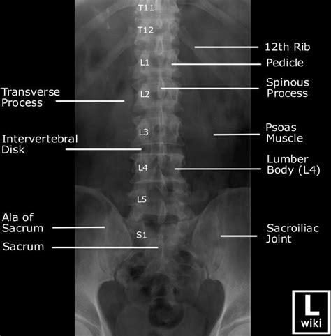 Radiographic Anatomy - Lumber Spine AP | Radiology student, Diagnostic imaging, Radiology