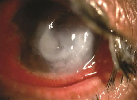 Microbial keratitis - American Academy of Ophthalmology