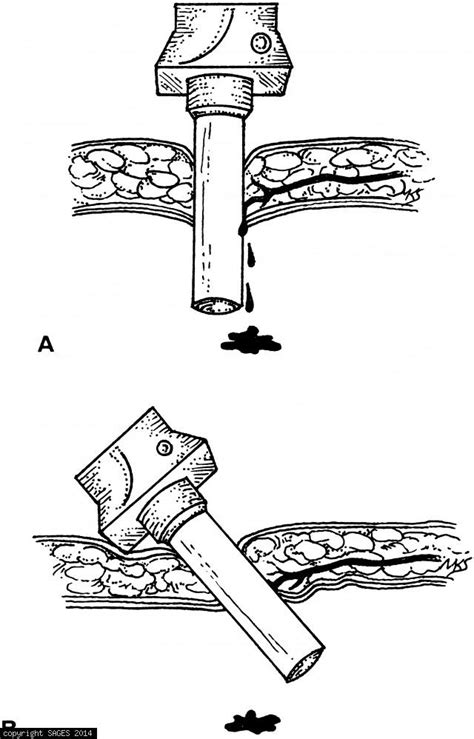 Bleeding From Trocar Site -SAGES Image Library