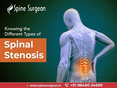 Knowing the Different Types of Spinal Stenosis and overview of Lumbar ...