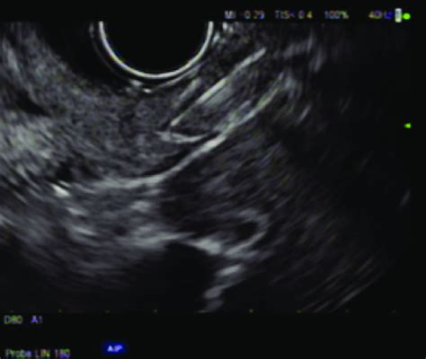 The pyloric sphincter as seen by EUS with total thickness of 7-8 mm... | Download Scientific Diagram