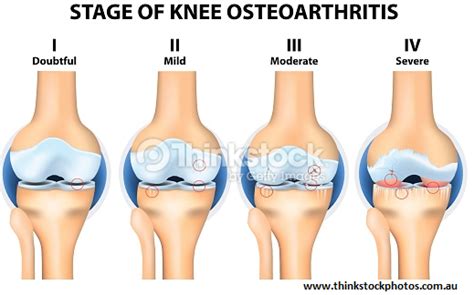 Knee Osteoarthritis | ZYEX Physiotherapy & Rehabilitation Center