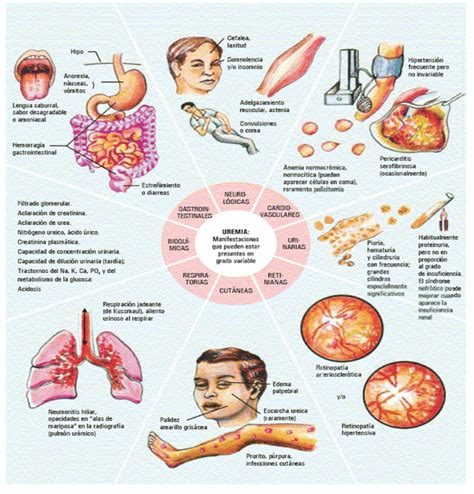 What is Uremia?