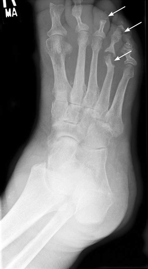 Diagnosis and Management of Osteomyelitis | AAFP