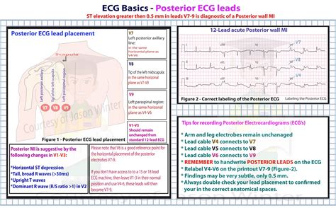 18 Lead Ekg Placement Diagram