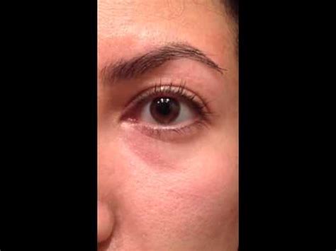 What Causes Eyelid Twitches Myokymia And How To Treat It