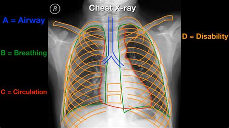 Read and Interpret Chest X-rays - The ABCDE Mnemonic Step-By-Step ...