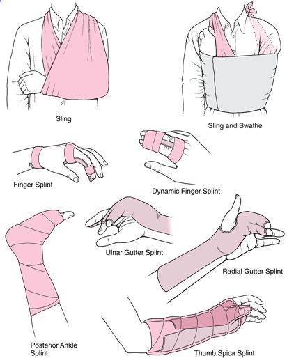 Various splints for broken bones. Do you know what is a SAM Splint? It ...