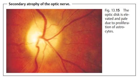 Atrophy of the Optic Nerve