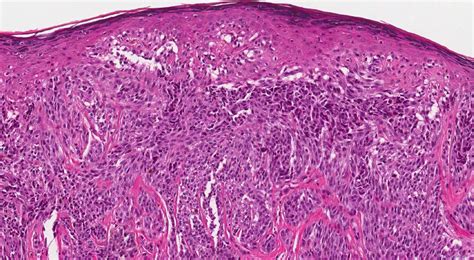 Spitz nevus | Ottawa Atlas of Pathology