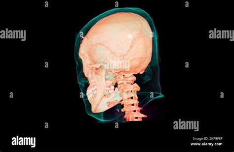 Skull fracture ct scan Stock Videos & Footage - HD and 4K Video Clips ...