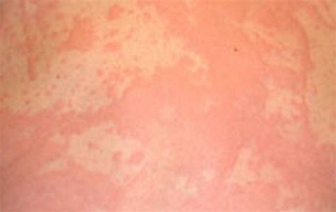 Stress Rash: Causes, Symptoms, Pictures, & Treatment | HubPages