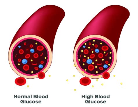 What Is High Blood Sugar? - BloodGlucoseValue.com