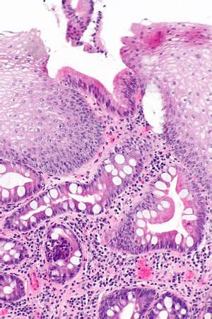 Barrett's esophagus - Libre Pathology