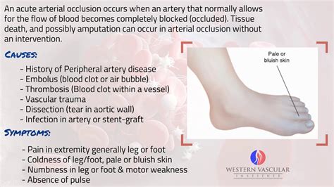 Acute Artery Blockage - YouTube