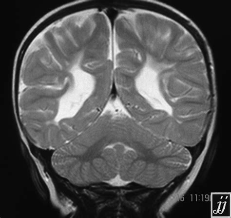 Agenesis of corpus callosum, COM – Radiopaedia