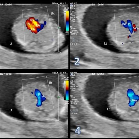 Ultrasound examination in the second trimester of the same fetus ...