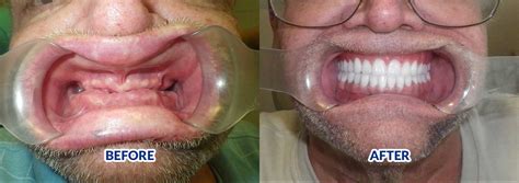 Before and After - Snap in Dentures | Snapindentures