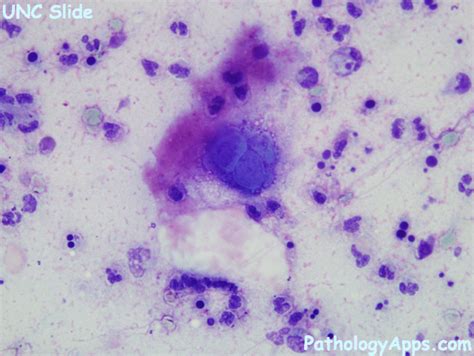 hsv cervix cytology