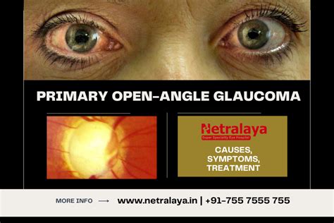 Primary Open-Angle Glaucoma: Causes, Symptoms, Treatment - Netralaya