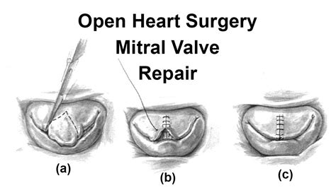 Mitral Valve Replacement