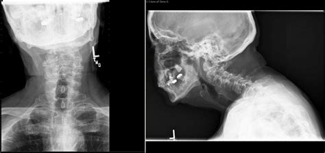 Case Study: Surgical management with Odontoid Fractures