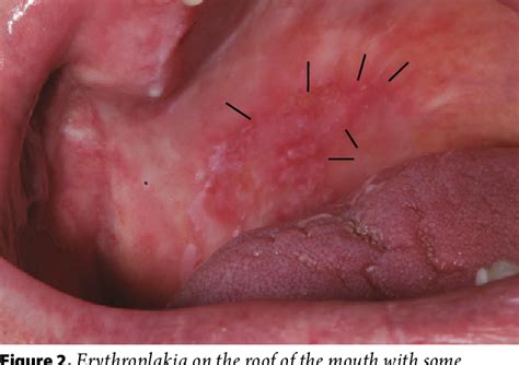 Figure 2 from Medical Imaging of Oral and Oropharyngeal Cancer. | Semantic Scholar